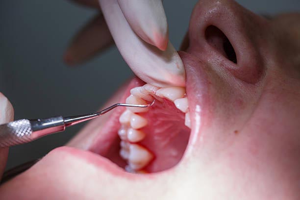 Dental Implants